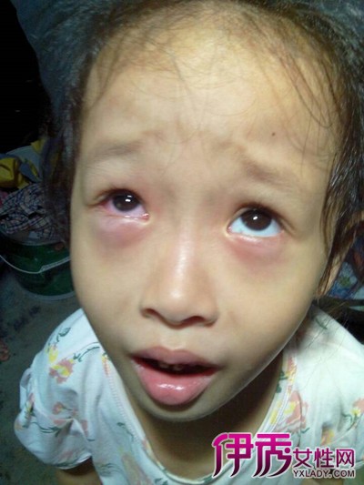 小孩眼结膜水肿图片图片