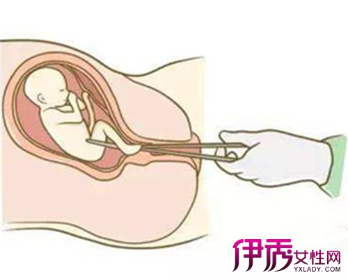 【怀孕初期怎么流产最安全】【图】怀孕初期怎