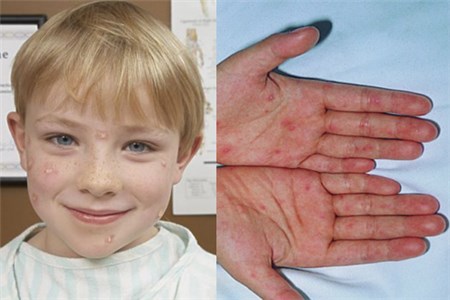 【图】儿童水痘初期症状 学会提前预防