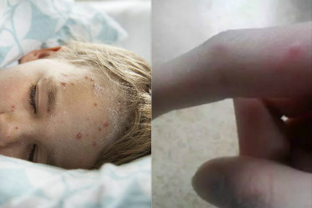 【图】水痘初期症状图片展示 教你几种治疗秘诀