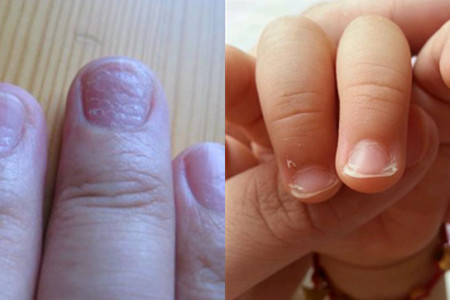 【图】孩子手指甲凹凸不平是为何 细节反映健康状态