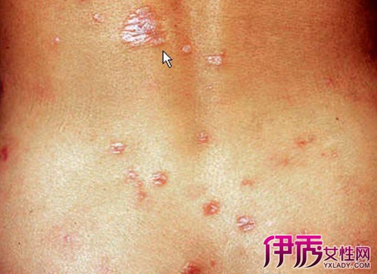 【图】梅毒症状图片 男性梅毒症状的表现