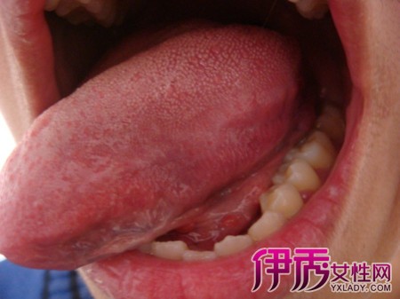 【图】艾滋病初期症状舌头显危机 区别艾滋看舌头