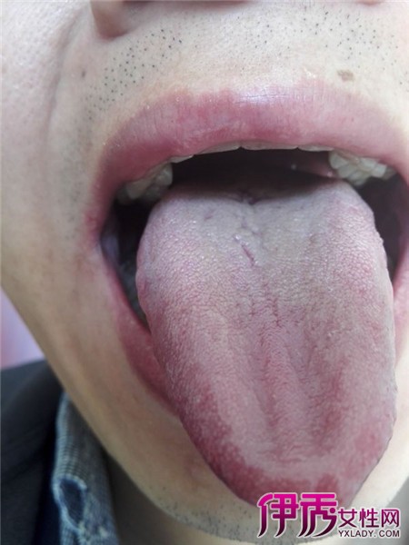 腭舌弓滤泡增生图片