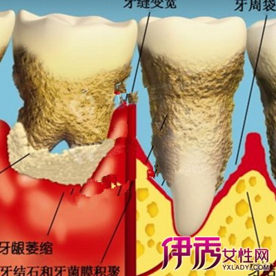 【图】牙周炎图片展示 四大病因导致牙周炎的形成