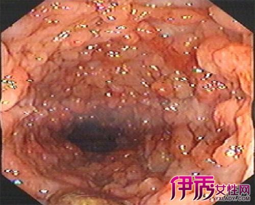 女性肠癌早期症状图片