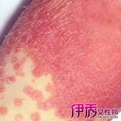 老公感染霉菌的图片图片