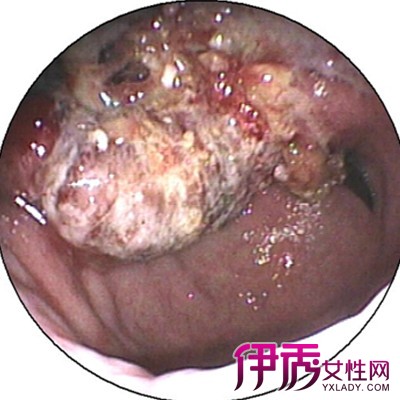 食道炎的早期症状图片