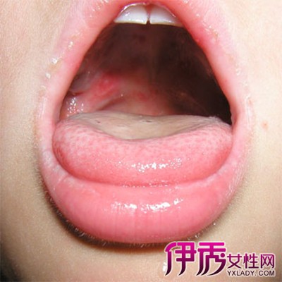 【图】口腔疱疹图片展示 解密口腔胞疹的病因和治疗方法