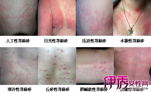 【风包的症状和图片】【图】风包的症状和图片 荨