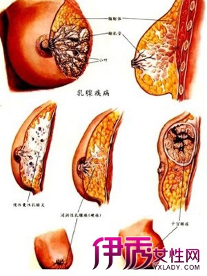 乳腺增生的照片图片