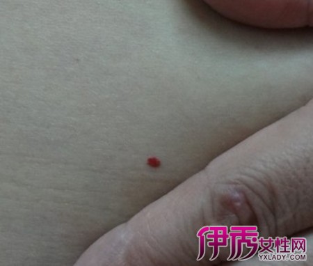 乳房下长红痣图片