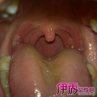 怎么看出喉咙发炎图片图片