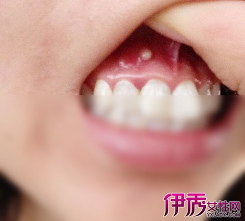 【图】牙龈脓包能挤破吗 三种小妙招为你解除烦恼
