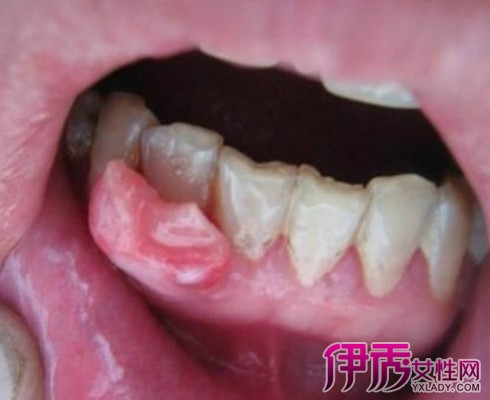 牙龈炎肉芽增生图片图片