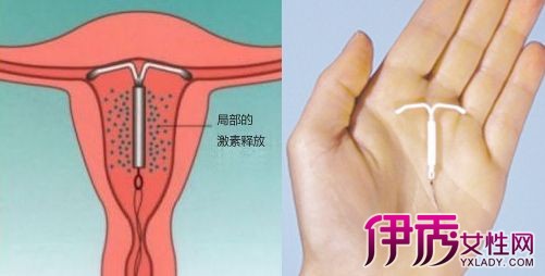 节育环好处_节育环哪种好_节育环利与弊