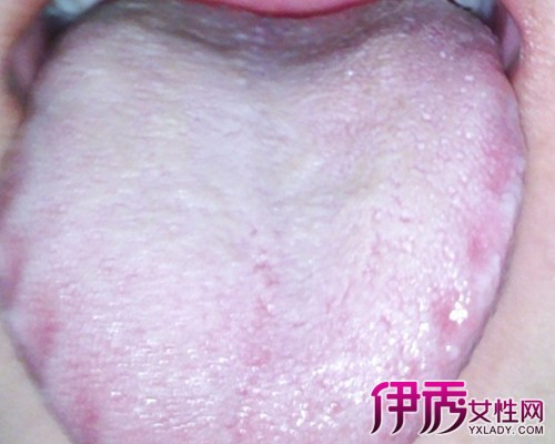 【图】口腔白色念珠菌症状有什么 口腔念珠菌病的典型症状