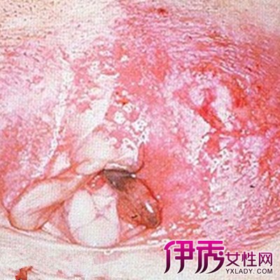 阴部湿疹的症状图片