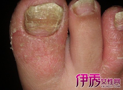 【图】脚指甲变黄变厚原因何在 原来都是灰指甲惹的祸