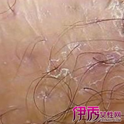 毛囊炎图片 女性 尿道图片