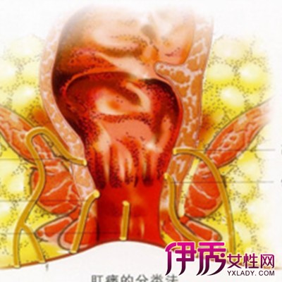 女性肠息肉的早期症状图片