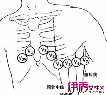 【图】心电图导联位置图片 详解心电图各波及波段的8个组成部分