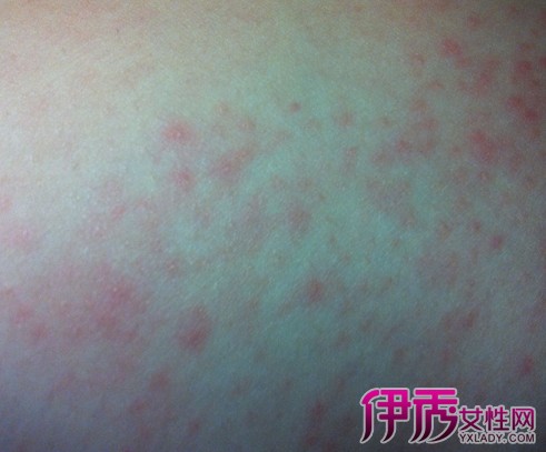 【图】大腿上长了很多小红点很痒 该症状的6个