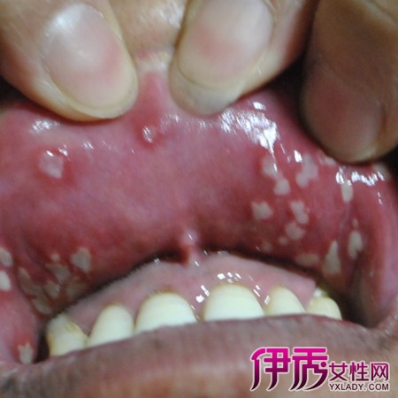 口腔溃疡恢复过程图图片