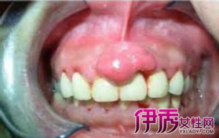 牙龈息肉症状图片