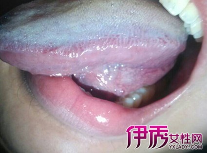 【圖】舌頭白斑怎麼辦 4大治療方法讓你擁有健康口腔