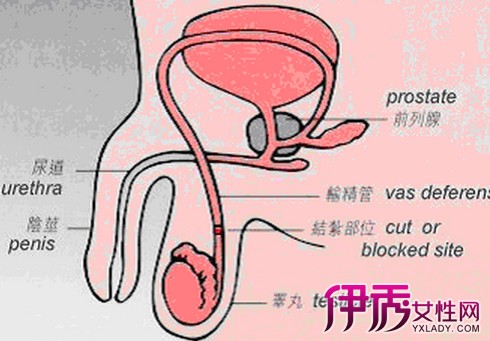 【图】男人结扎有什么坏处 揭示男性结扎后遗症