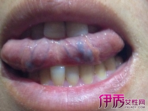 感染hpv舌头图片水泡图片
