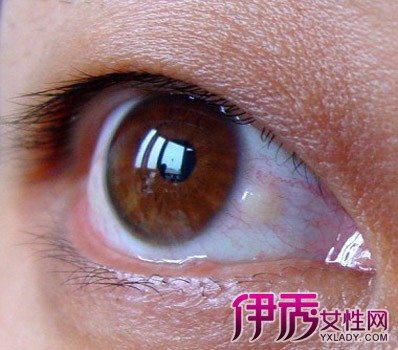 【图】眼白上长了个小水泡及时治疗 注意保护好眼睛