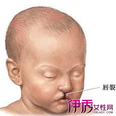 一度婴儿唇裂图图片
