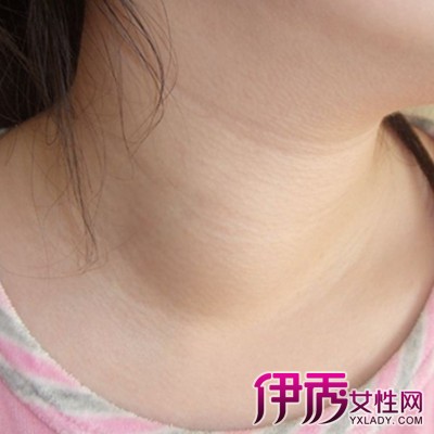 女性脖子右侧肿胀图片