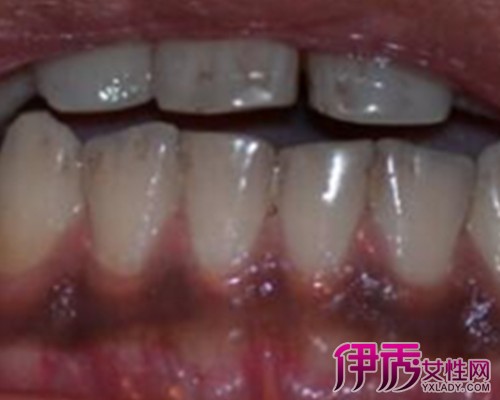 铅线牙龈图片