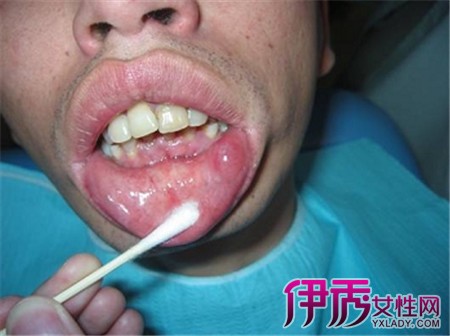 口腔唾液腺堵塞的图片图片