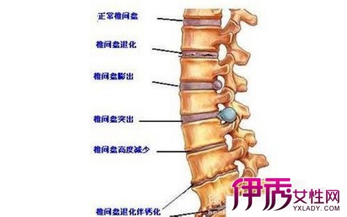 图 曝颈椎骨质增生图片 教你如何预防劲椎骨质增生