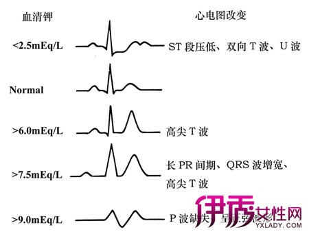 【图】异常心电图图谱图解 教你如何分析三大常见异常心电图