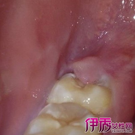 干槽症牙洞图片
