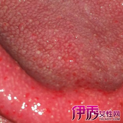 舌头红色颗粒状图片图片