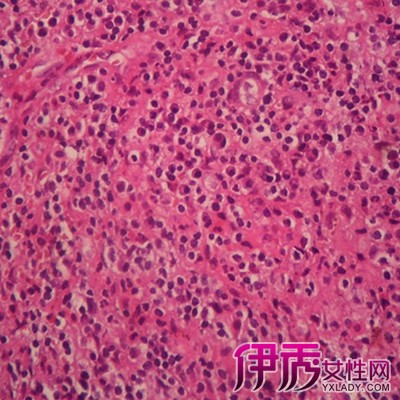 前庭大腺肿瘤图片图片