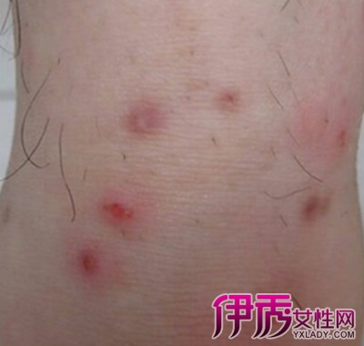 女性梅毒症状图片图片