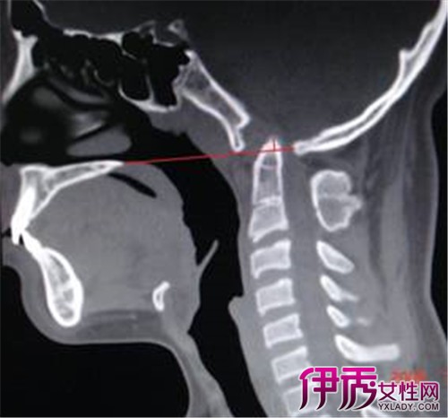 【图】枕骨骨折有哪些临床症状 4大临床症状引起病发