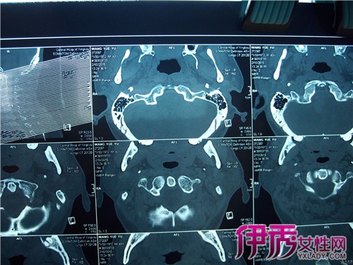 【图】枕骨骨折有哪些临床症状 4大临床症状引起病发