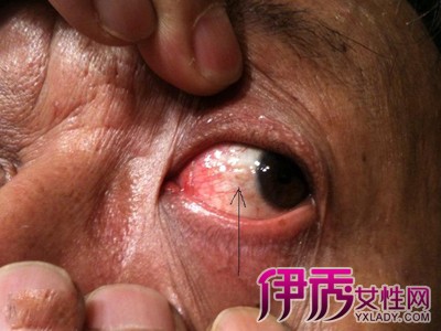【图】眼球上长了个小疙瘩怎么回事 疱疹性结膜炎和眼睑裂斑的治疗
