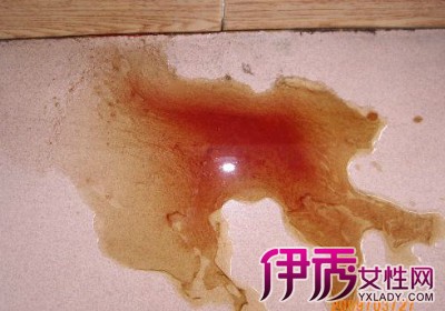 酱油色血尿图片