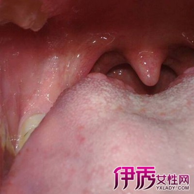 舌根轮廓状乳头大小图片