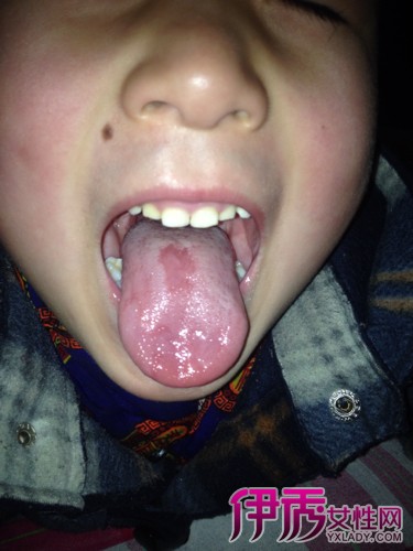 舌头疱疹症状图片