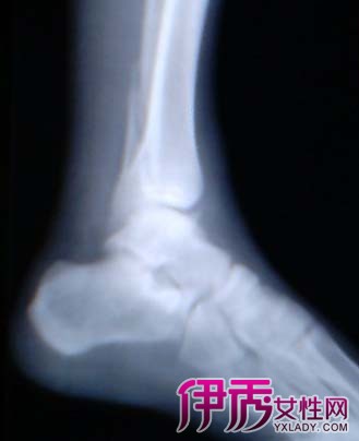 【图】右脚外踝骨折图片鉴赏 分享骨折病人吃